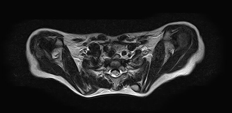 File:Bilateral Sprengel deformity with Klippel-Feil syndrome (Radiopaedia 66395-75650 Axial T2 20).jpg