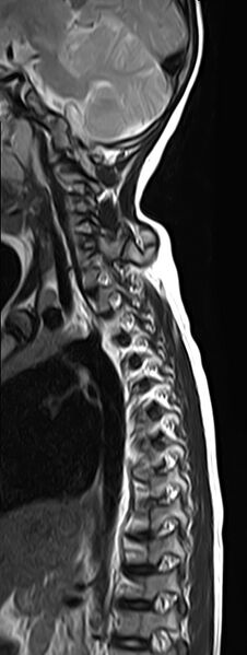 File:Bilateral Sprengel deformity with Klippel-Feil syndrome (Radiopaedia 66395-75650 Sagittal T2 9).jpg
