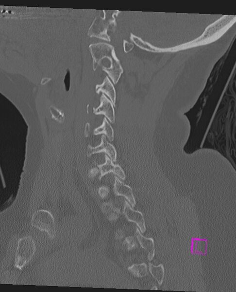 File:Bilateral atlanto-occipital assimilation (Radiopaedia 28350-28603 Sagittal bone window 30).jpg