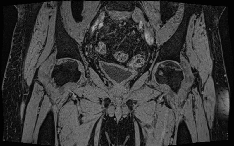 File:Bilateral avascular necrosis of femoral head (Radiopaedia 77116-89078 Coronal T2 we 46).jpg