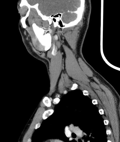 File:Bilateral carotid body tumors (Radiopaedia 52899-58827 C 47).jpg