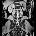 Bilateral conjoined nerve roots at different levels (Radiopaedia 73312-84063 Coronal WE 32).jpg