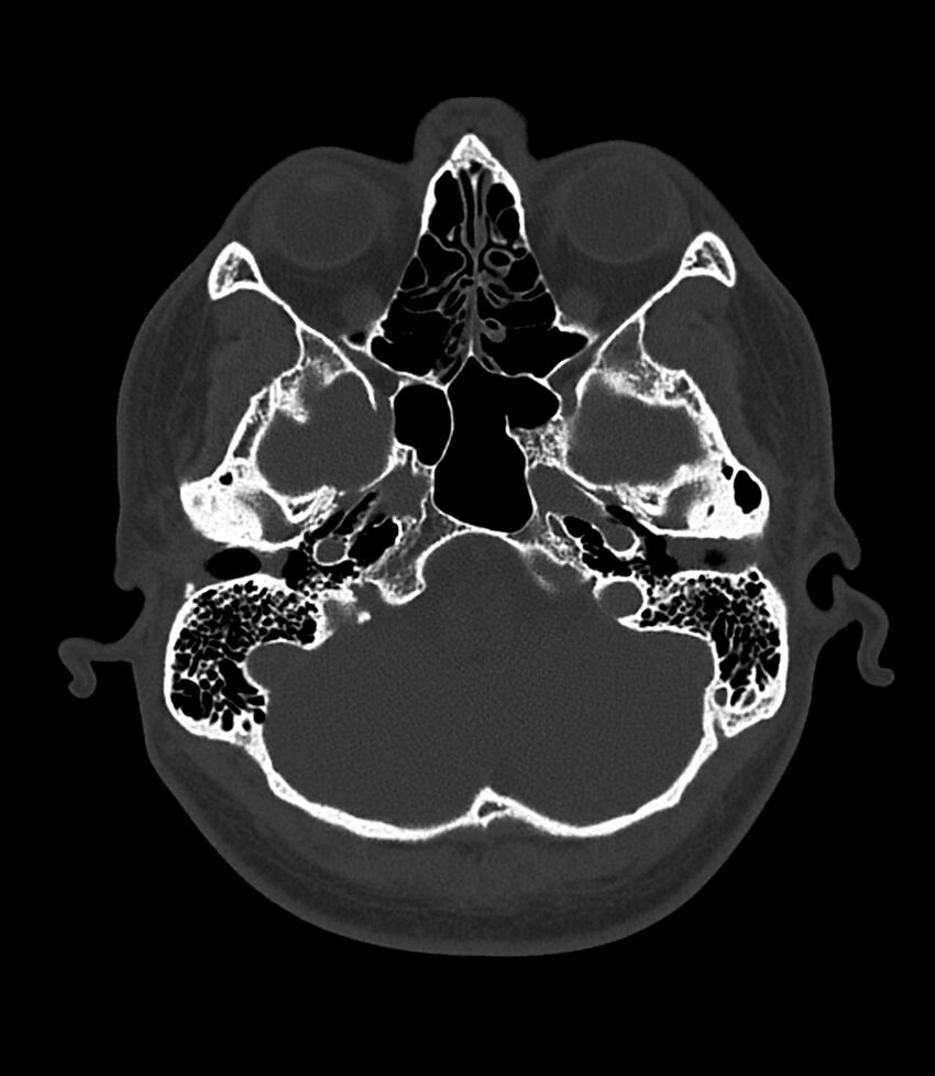 Bilateral medial canal fibrosis (Radiopaedia 85598-101344 Axial bone window 23).jpg