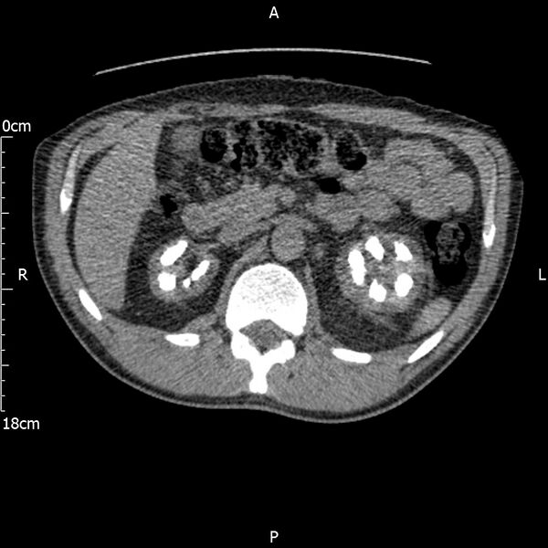 File:Bilateral medullary nephrocalcinosis with ureteric calculi (Radiopaedia 71269-81569 Axial non-contrast 37).jpg