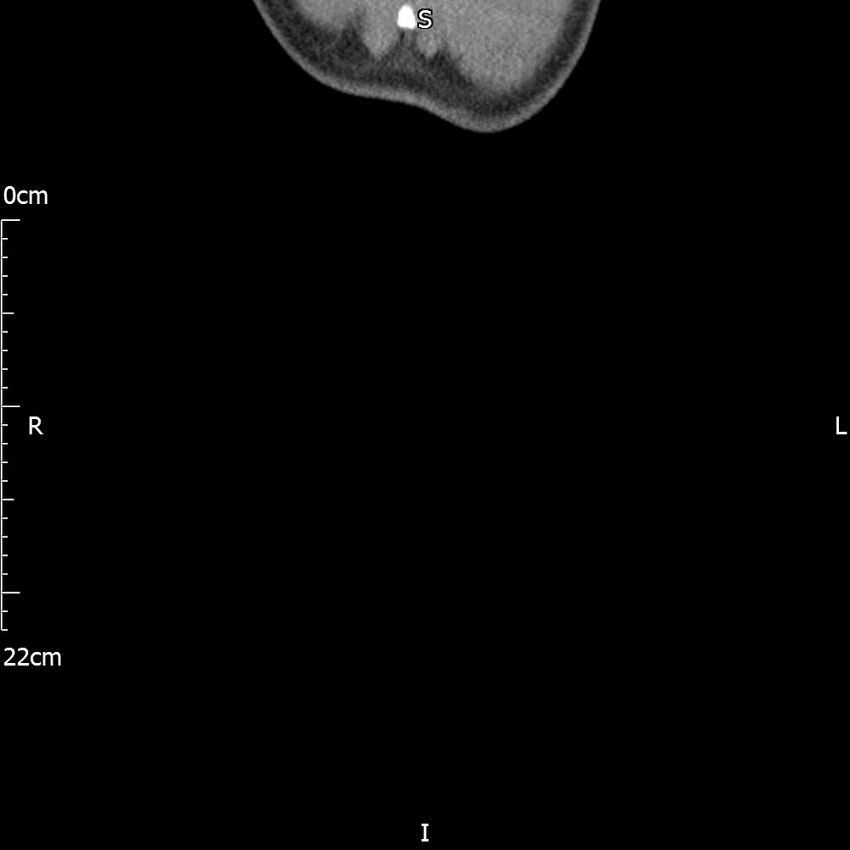 Bilateral medullary nephrocalcinosis with ureteric calculi (Radiopaedia 71269-81569 Coronal non-contrast 82).jpg