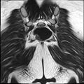 Bilateral ovarian endometriomas (Radiopaedia 87085-103347 Coronal T2 22).jpg