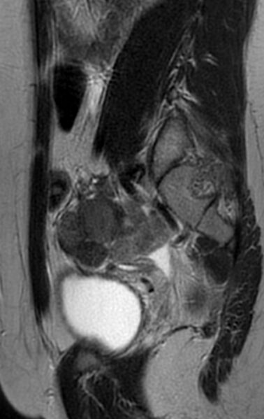 File:Bilateral ovarian fibrothecomas - adolescent (Radiopaedia 86604-102707 Sagittal T2 24).jpg