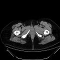 Bilateral ovarian mature cystic teratomas (Radiopaedia 79373-92457 Axial non-contrast 104).jpg