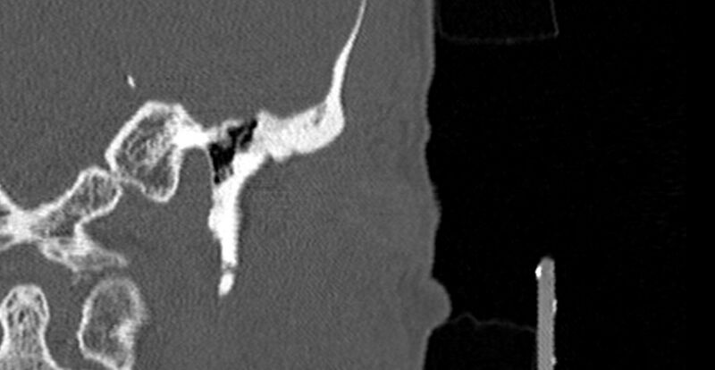 File:Bilateral temporal bone fractures (Radiopaedia 29482-29970 B 5).jpg
