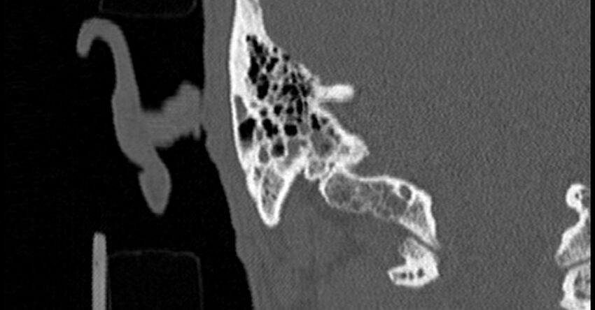 Bilateral temporal bone fractures (Radiopaedia 29482-29970 Coronal non-contrast 157).jpg