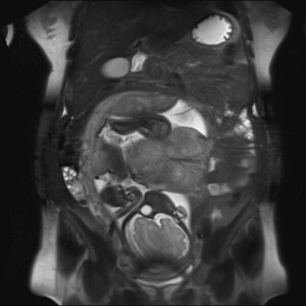 File:Bilobed placenta accreta (Radiopaedia 69648-79591 Coronal T2 fat sat 20).jpg