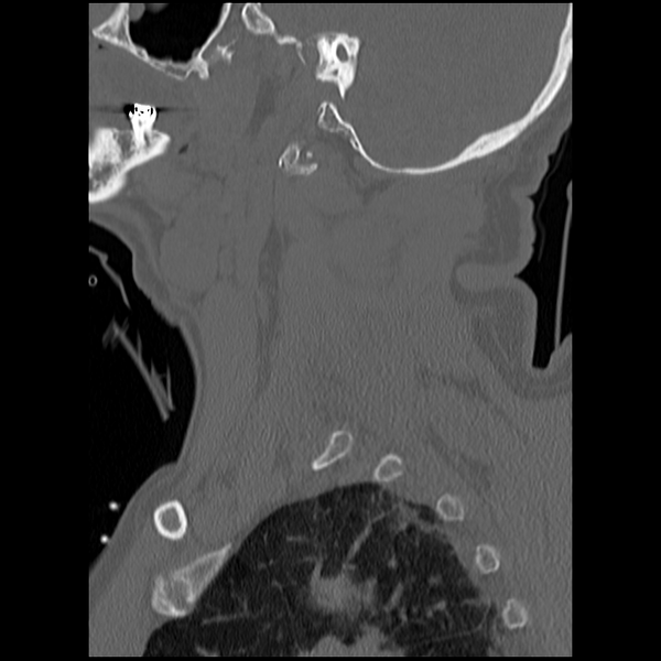 File:Blunt cerebrovascular injury (Radiopaedia 53682-59743 Sagittal bone window 1).png