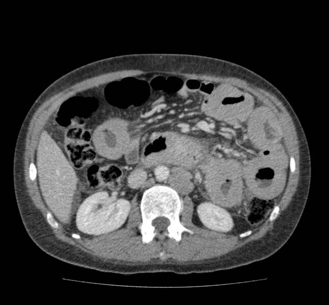 File:Bowel lymphoma complicated by bleeding after therapy (Radiopaedia 55601-62107 A 36).jpg