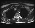 Brachial plexus birth palsy (Radiopaedia 68118-77604 Axial T2 23).jpg
