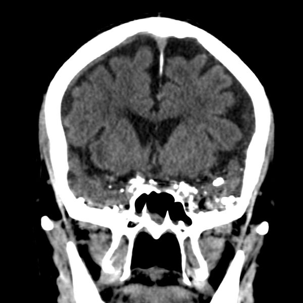 File:Brain Pantopaque remnants (Radiopaedia 78403-91048 Coronal non-contrast 28).jpg