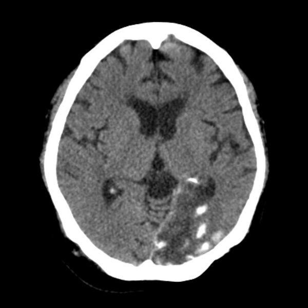 File:Brain cortical laminar necrosis (Radiopaedia 25822-25971 Axial non-contrast 22).jpg