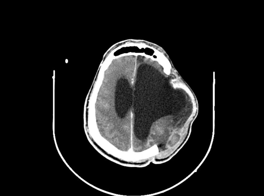 Brain injury by firearm projectile (Radiopaedia 82068-96088 B 159).jpg
