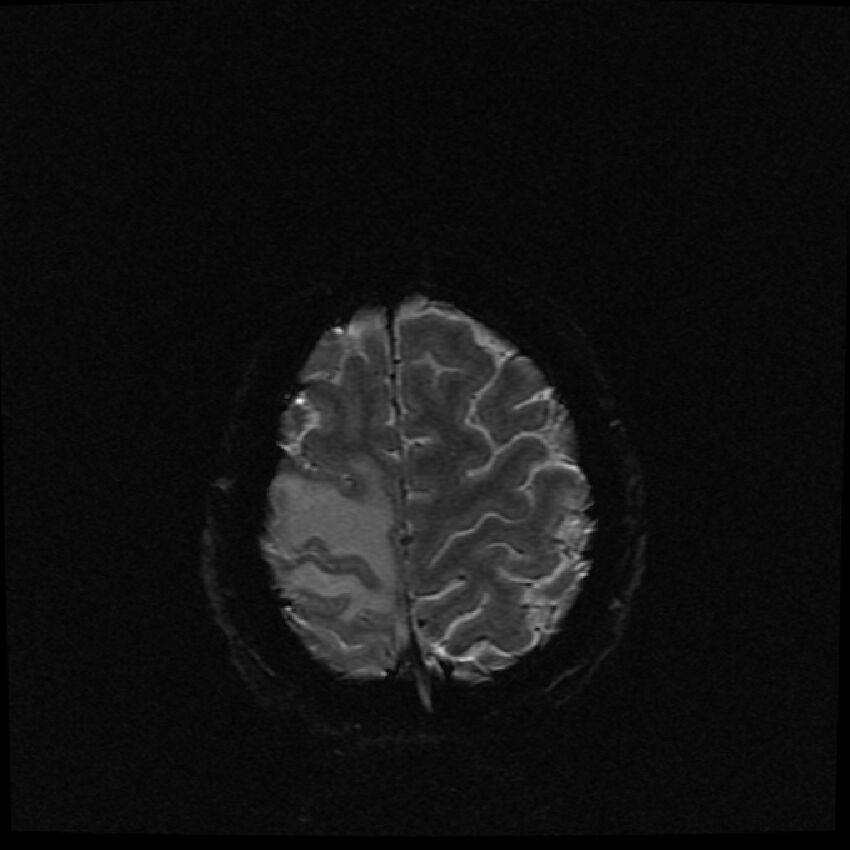 Brain metastases (renal cell carcinoma) (Radiopaedia 42571-45704 Axial SWI 4).jpg