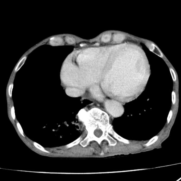File:Brain metastases from lung cancer (Radiopaedia 27849-28093 D 48).jpg