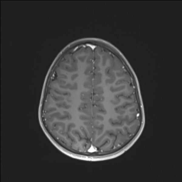 File:Brainstem glioma (Radiopaedia 70548-80674 Axial T1 C+ 118).jpg