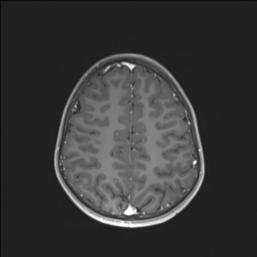 Brainstem glioma (Radiopaedia 70548-80674 Axial T1 C+ 118).jpg