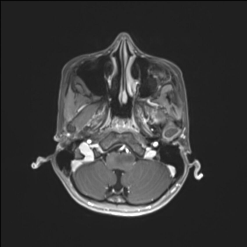 Brainstem glioma (Radiopaedia 70548-80674 Axial T1 C+ 30).jpg