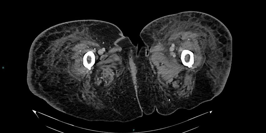 Breast cancer pelvic bony metastases (Radiopaedia 84470-99824 Axial bone window 84).jpg