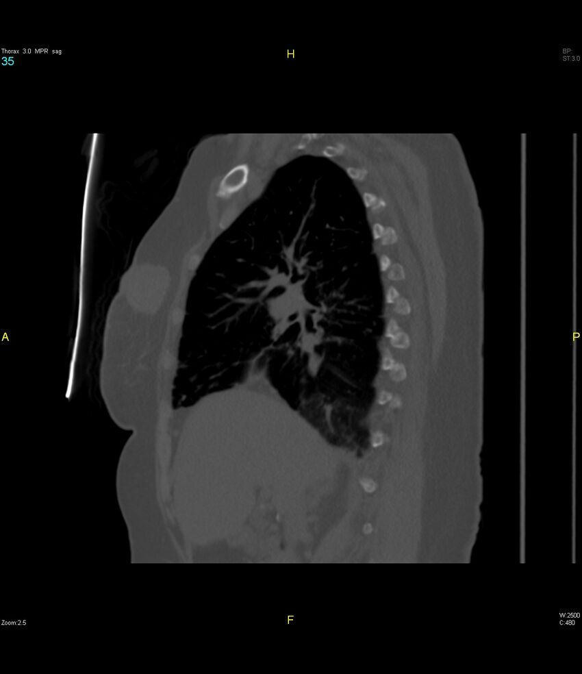Breast primary with lung and bone metastases (Radiopaedia 40620-43228 Sagittal bone window 35).jpg