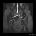 Broad ligament fibroid (Radiopaedia 49135-54241 Coronal STIR 19).jpg