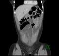 Broad ligament hernia (Radiopaedia 63260-71832 B 7).jpg