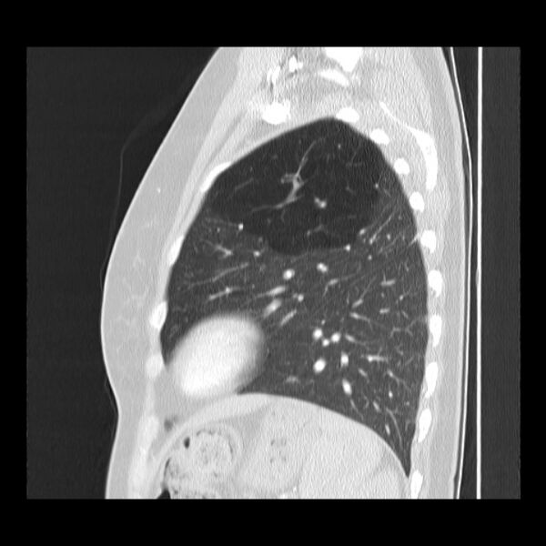 File:Bronchial atresia (Radiopaedia 22965-22992 Sagittal lung window 14).jpg