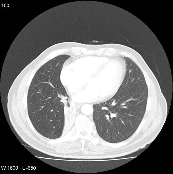 File:Bronchial carcinoid tumor with right lower lobe collapse (Radiopaedia 29060-29422 B 38).jpg