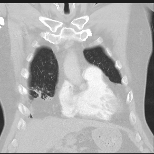 File:Bronchiectasis (Radiopaedia 39385-41666 Coronal lung window 6).png