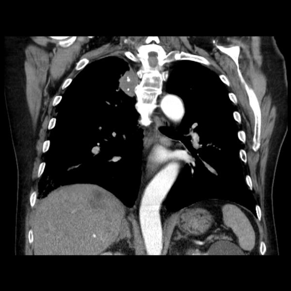File:Bronchogenic adenocarcinoma and pulmonary embolism (Radiopaedia 9097-9806 C 32).jpg