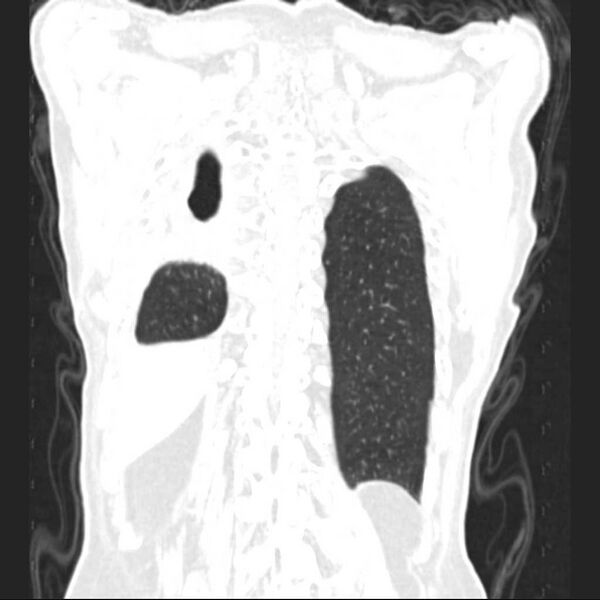 File:Bronchopleural fistula - postoperative complication (Radiopaedia 21020-20947 Coronal lung window 24).jpg
