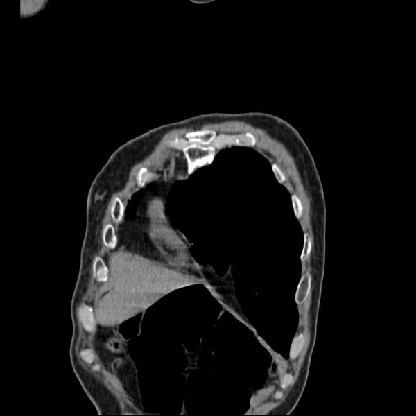 File:Bronchopleural fistula - postoperative complication (Radiopaedia 21020-20947 Coronal non-contrast 4).jpg