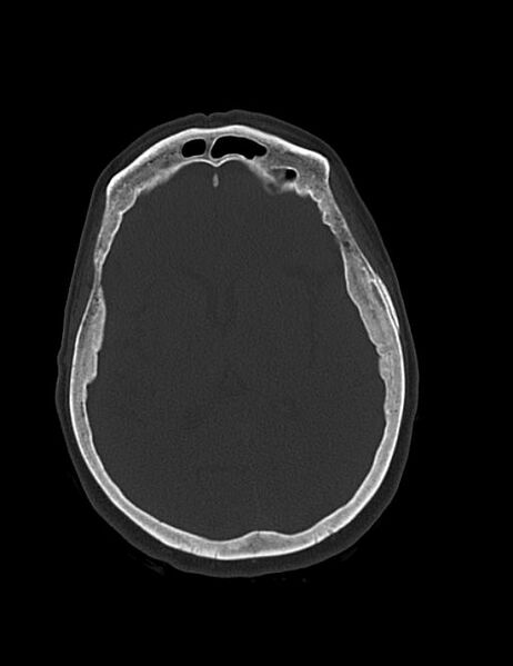 File:Burnt-out meningioma (Radiopaedia 51557-57337 Axial bone window 26).jpg