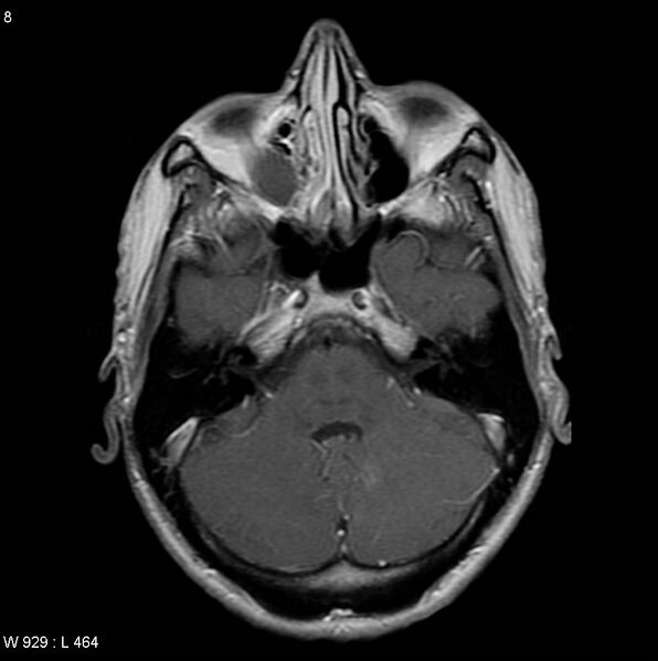 File:CMV ventriculitis and encephalitis (Radiopaedia 5416-7166 Axial T1 C+ 1).jpg