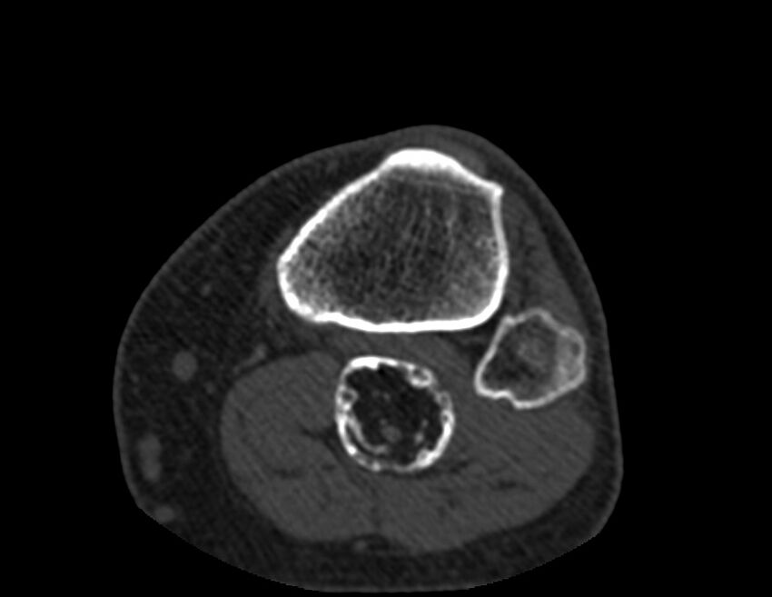 Calcified hematoma - popliteal fossa (Radiopaedia 63938-72763 Axial bone window 76).jpg