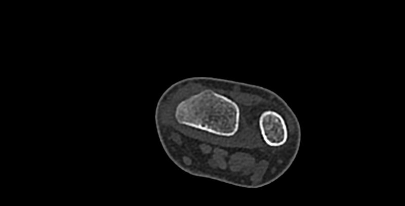 File:Calcifying aponeurotic fibroma (Radiopaedia 88423-105064 Axial bone window 10).jpg