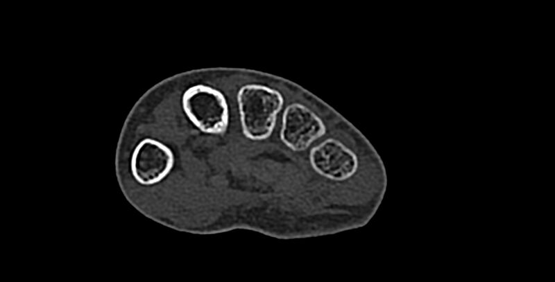 File:Calcifying aponeurotic fibroma (Radiopaedia 88423-105064 Axial bone window 135).jpg