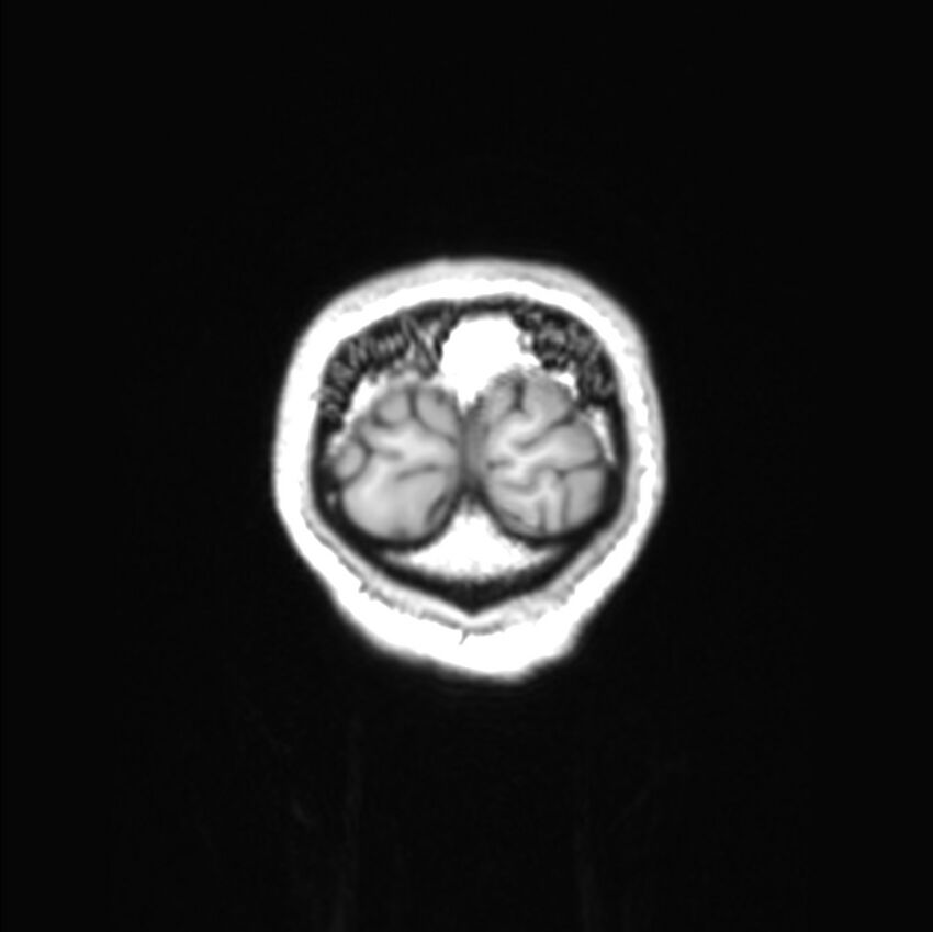 Callosal dysgenesis with interhemispheric cyst (Radiopaedia 53355-59335 Coronal T1 7).jpg