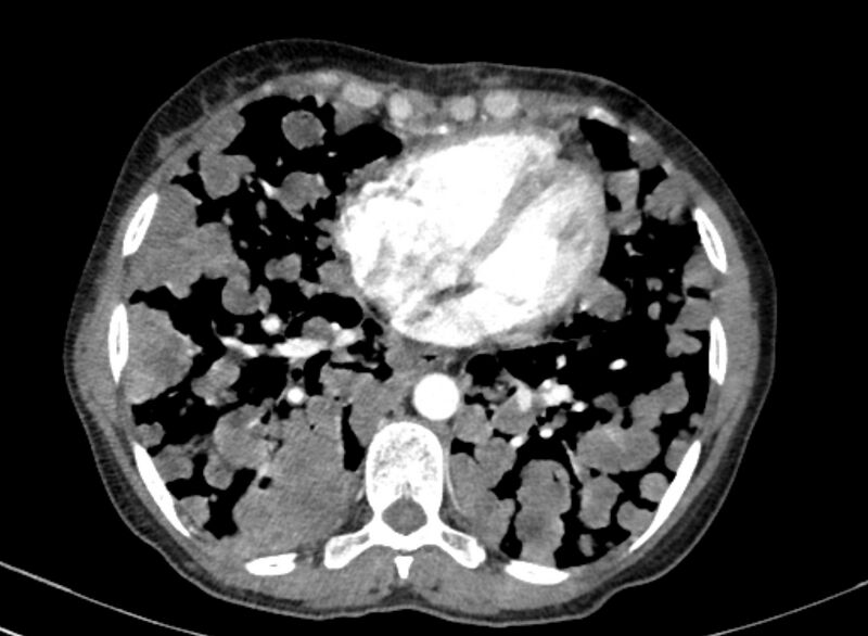 File:Cannonball metastases from breast cancer (Radiopaedia 91024-108569 A 80).jpg