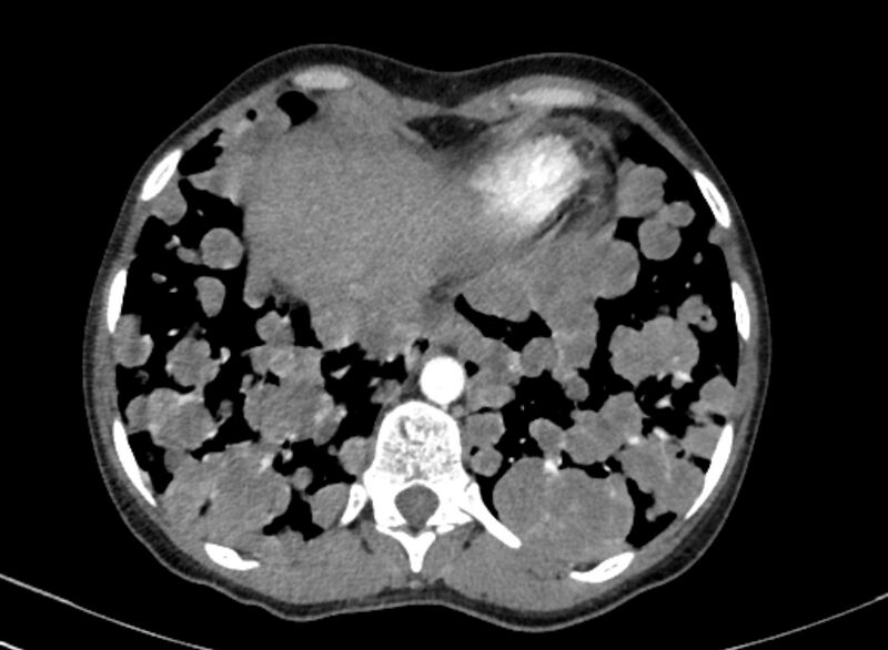 File:Cannonball metastases from breast cancer (Radiopaedia 91024-108569 A 98).jpg