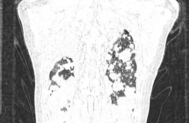 File:Cannonball metastases from breast cancer (Radiopaedia 91024-108569 Coronal lung window 129).jpg