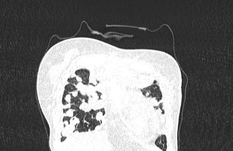 File:Cannonball metastases from breast cancer (Radiopaedia 91024-108569 Coronal lung window 17).jpg