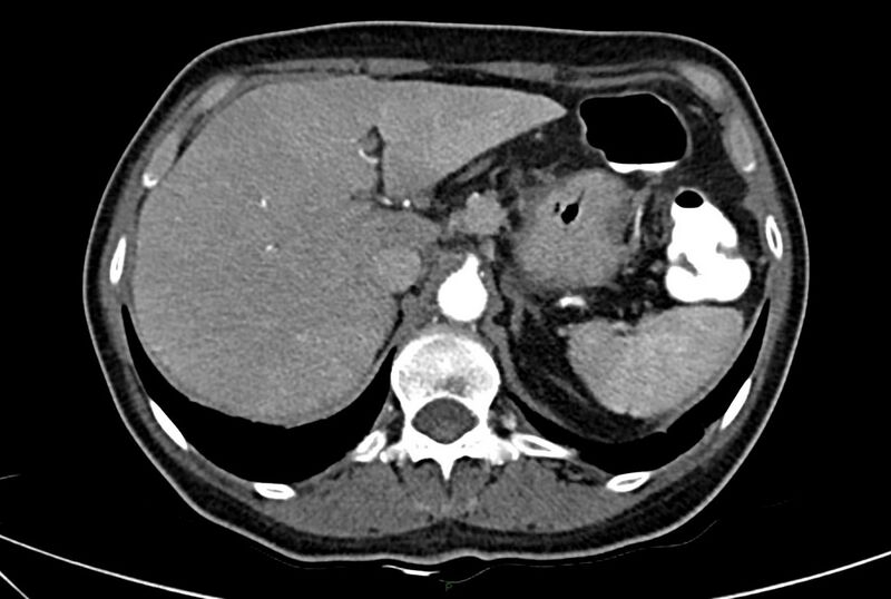 File:Carcinoid mesenteric tumor complicated by chylous ascites (Radiopaedia 76312-88926 A 16).jpg