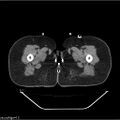 Carcinoma cervix- brachytherapy applicator (Radiopaedia 33135-34173 Axial non-contrast 65).jpg