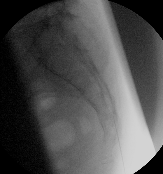 File:Caudal epidural injection (Radiopaedia 45123-49099 lateral 1).PNG