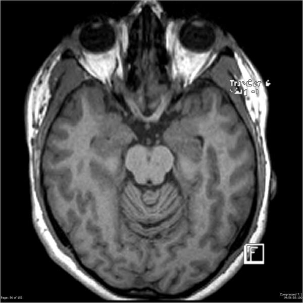 File:Cavernous malformation (cavernous angioma or cavernoma) (Radiopaedia 36675-38237 Axial T1 45).jpg